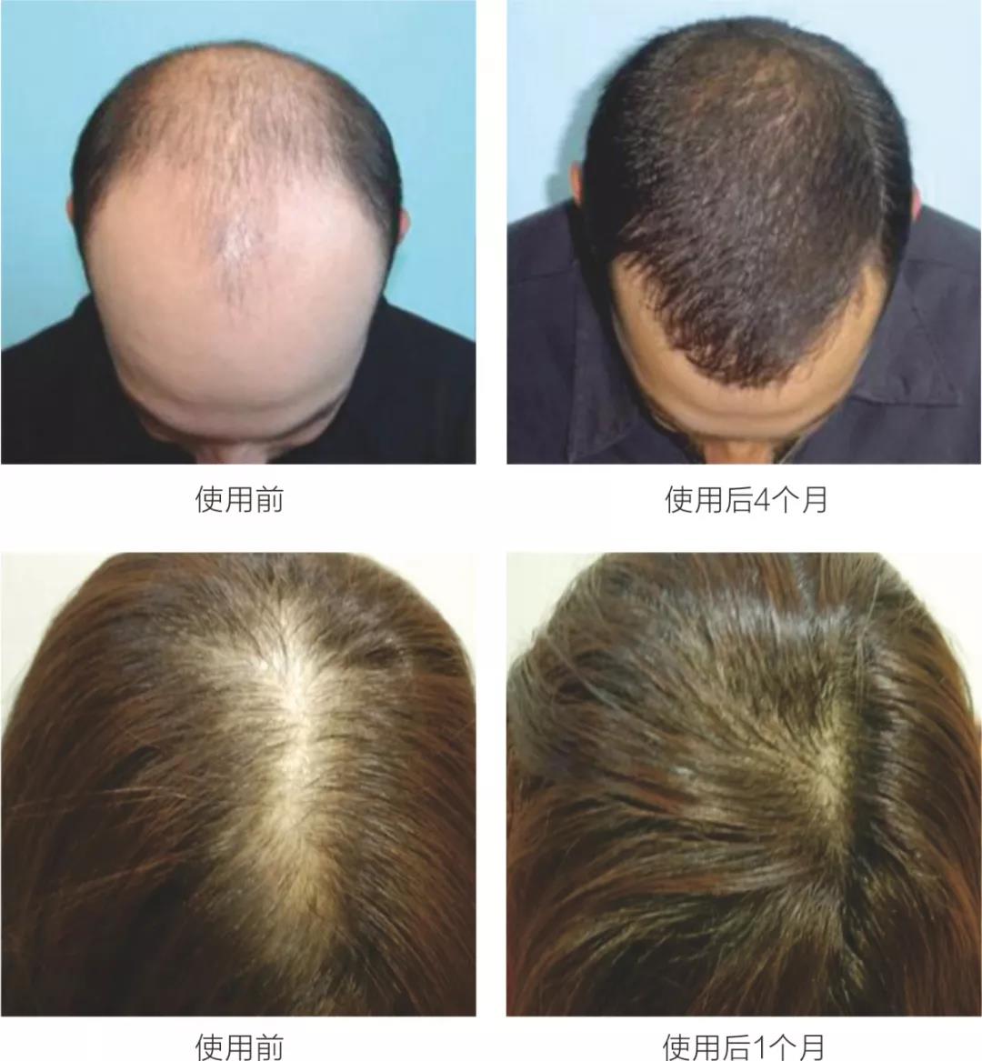 防脱生发